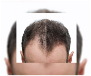 Gélules contre la chute des cheveux à effet épaississant et fortifiant Follixin 60 gélules