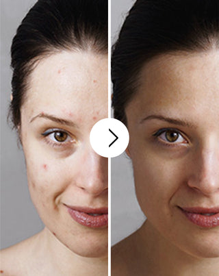 Comprimés pour l’acné, les boutons et les imperfections avec zinc, vitamine C, E et B2 Derminax - 6