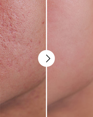 Comprimés pour l’acné, les boutons et les imperfections avec zinc, vitamine C, E et B2 Derminax