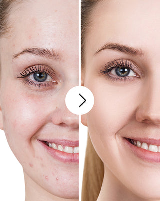 Comprimés pour l’acné, les boutons et les imperfections avec zinc, vitamine C, E et B2 Derminax_5 - 5