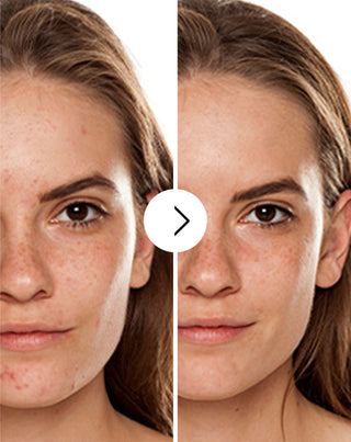 Comprimés pour l’acné, les boutons et les imperfections avec zinc, vitamine C, E et B2 Derminax_2 - 2