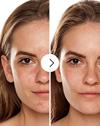 Comprimés pour l’acné, les boutons et les imperfections avec zinc, vitamine C, E et B2 Derminax_2 - 2