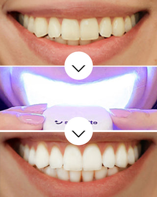 Kit de blanchiment des dents Light &amp; Bright avec lampe et gel - Smilebite